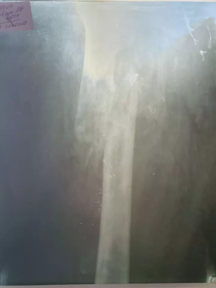 Любомльські лікарі вперше провели операцію онкохворій жінці з патологічним переломом стегна. ФОТО 18+ 3