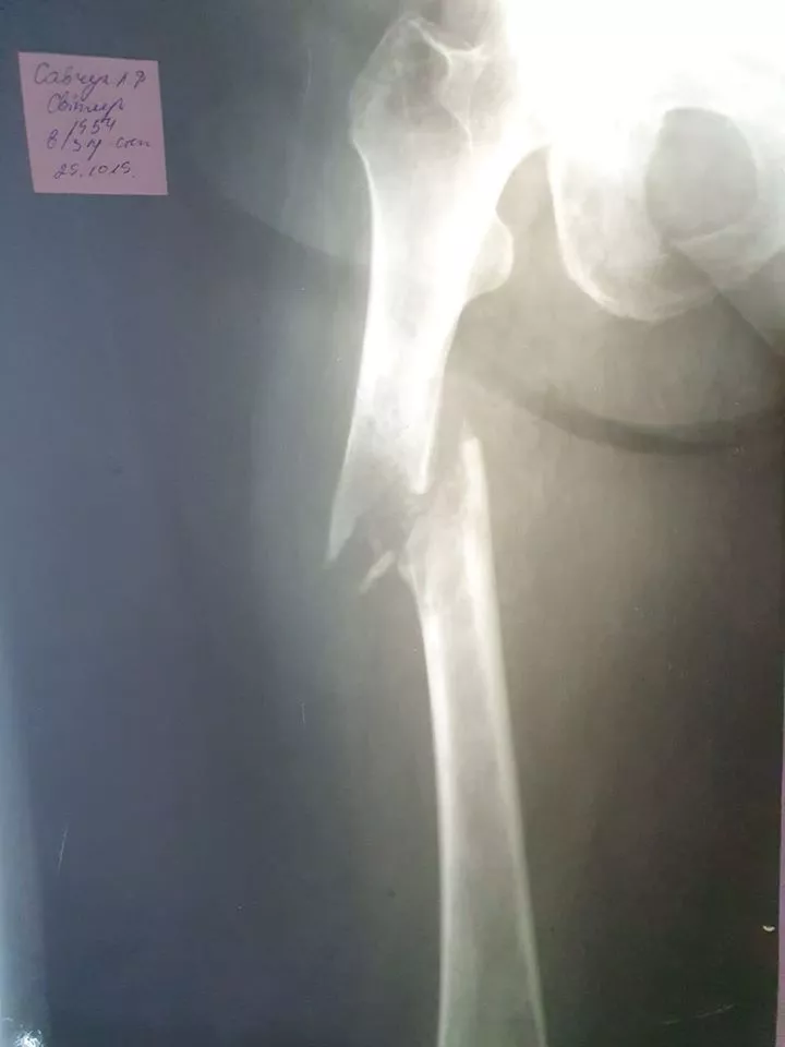 Любомльські лікарі вперше провели операцію онкохворій жінці з патологічним переломом стегна. ФОТО 18+ 4