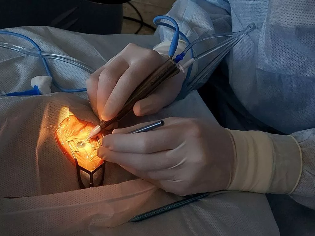 У Володимирі проводять офтальмологічну операцію по заміні штучного кришталика на оці 2