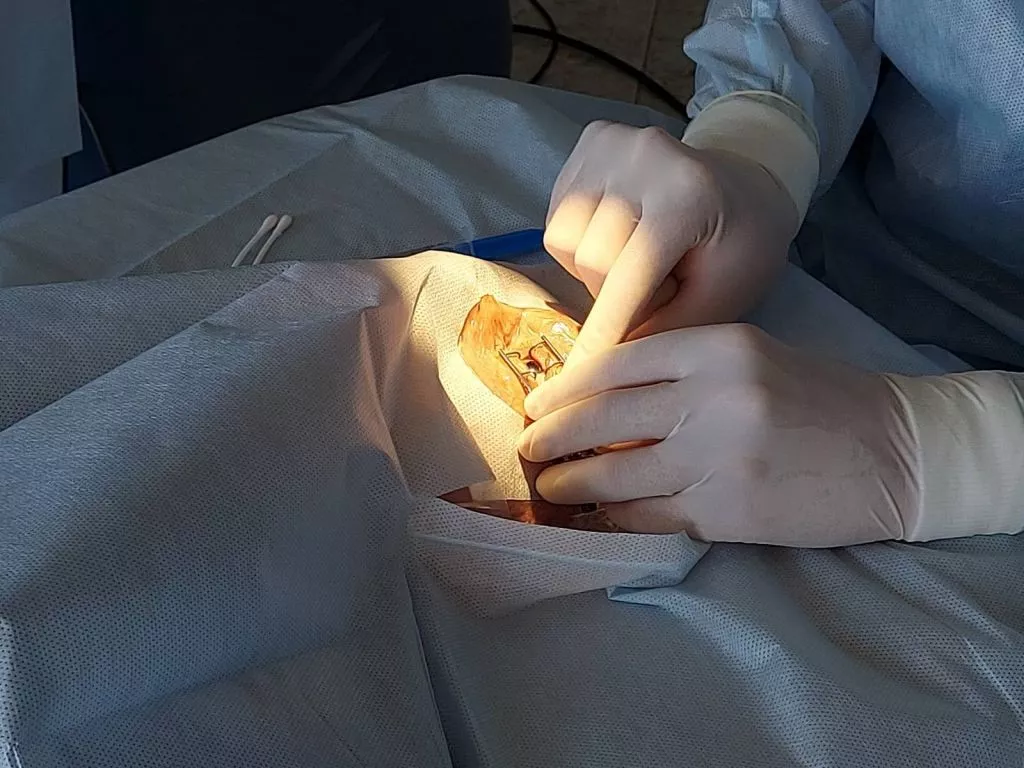 У Володимирі проводять офтальмологічну операцію по заміні штучного кришталика на оці 4