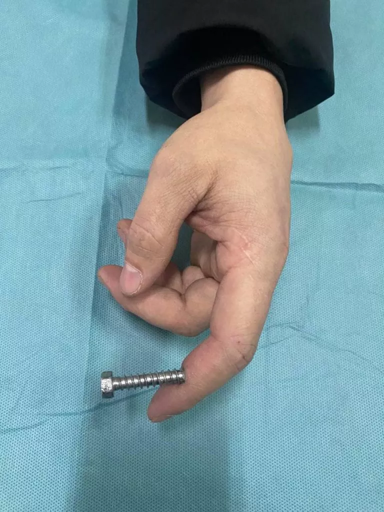 Чоловік закрутив шуруп собі у палець в Нововолинську 1