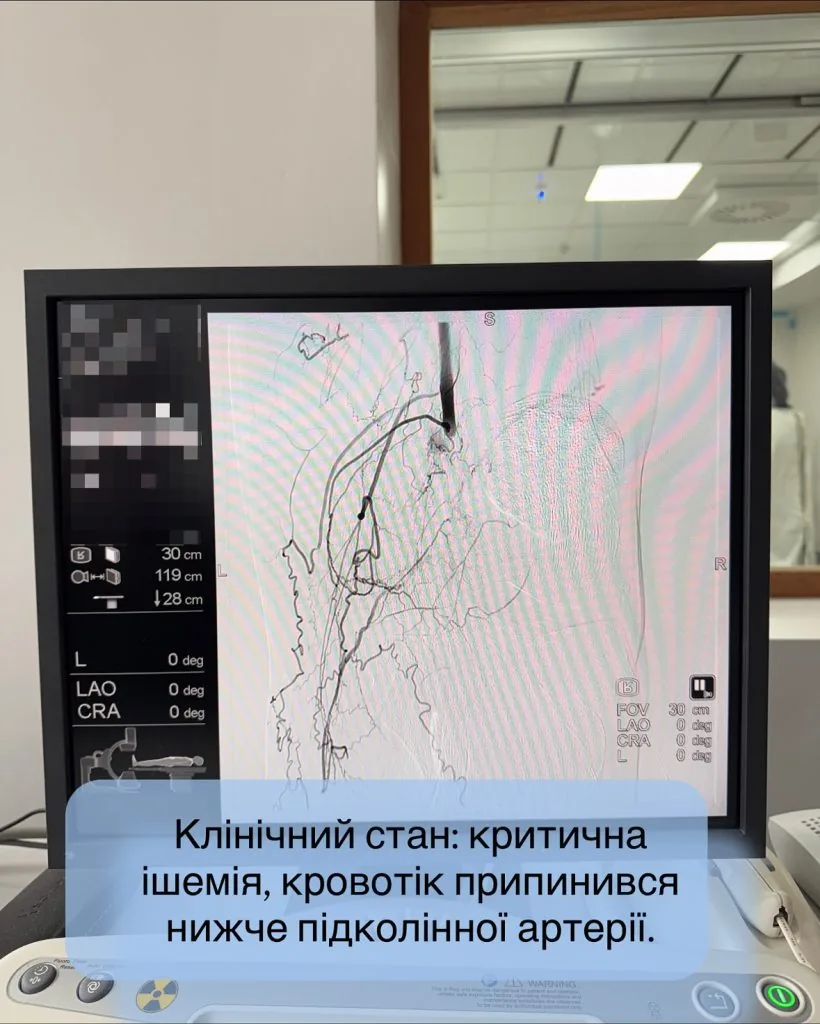Кінцівка «ожила» на операційному столі: у Нововолинську медики врятували ногу пацієнта від ампутації 2