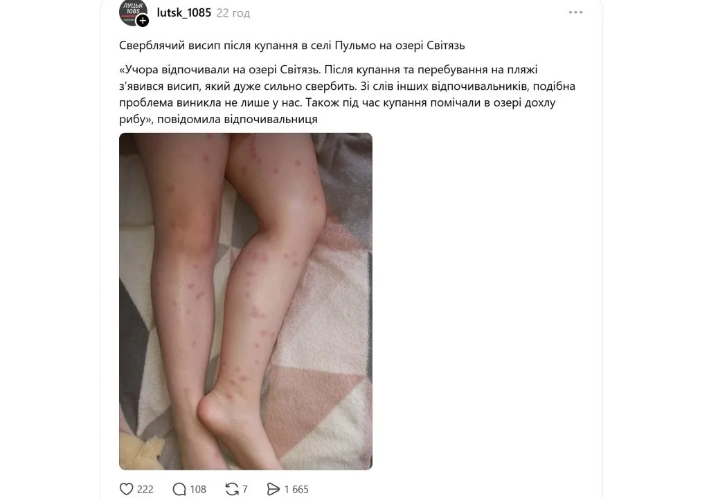 Церкаріоз або качині гельмінти: у мережі відпочивальники скаржаться на висип після купання в озері Світязь 1